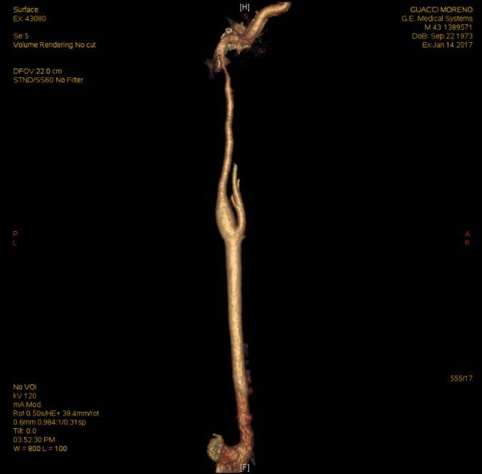 Caso clinico Figura 1: Angio-TC con ricostruzione 3D: si evidenzia il calibro filiforme dell arteria carotide interna destra nel suo tratto precranico.