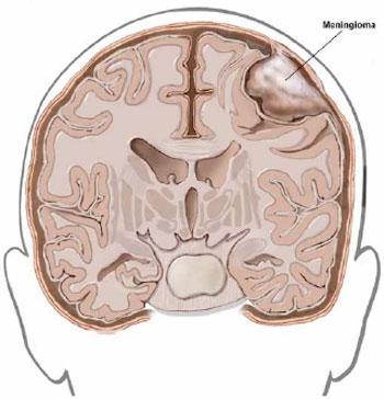 Origine: cellule stromali (meningoteli) aracnoidee meningiomi NAS Meningoteliale Fibroso