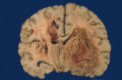 Glioma