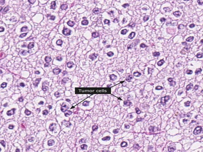 neoplasie del tessuto neuroepiteliale neoplasie oligodendrogliali Neoplasie oligoastrocitarie