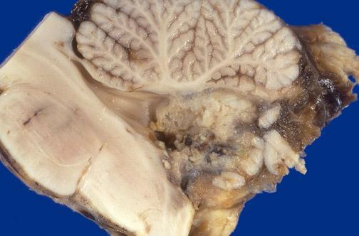 neoplasie embrionali Medulloblastoma M. desmoplastico/nodulare M. con nodularità estensive M.