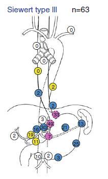 Ca del Cardias Siewert III sede delle metastasi linfonodali Di Leo A et al : Siewert III adenocarcinoma: treatment update. Updates Surg. 2017 Sep;69(3):319-325.