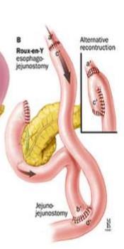 CANCRO DEL CARDIAS SIEWERT III ricostruzione della continuità intestinale La