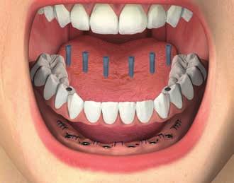 RIABILITAZIONE TOTALE CON PILASTRI SIMPLE Avvitare il provvisorio Simple in bocca controllandone la passivazione e le