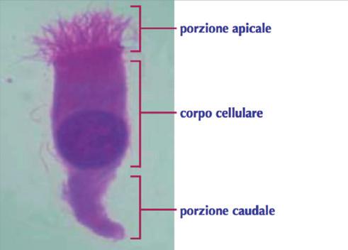 da Atlante di Citologia Nasale per la diagnosi differenziale delle rinopatie Gelardi M, II ediz. 2012 edi.ermes s.r.l. - Milano).