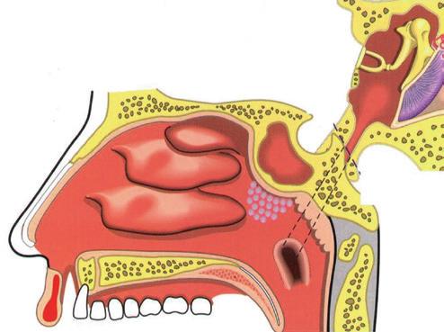 La citologia nasale nella diagnostica e nel monitoraggio della rinite nel bambino Recentemente uno studio condotto da Pipolo et al su 208 bambini avrebbe dimostrato la superiorità, sotto il profilo