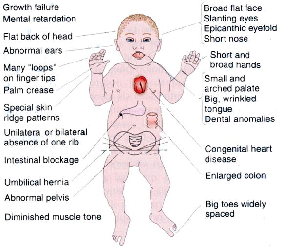 Segni clinici Sindrome di Down Ritardo nell accrescimento 100% Ritardo mentale 100% Occipite piatto 75% Orecchie ad impianto basso Anomalie dei dermatoglifi 85% Solco palmare trasverso Assenza