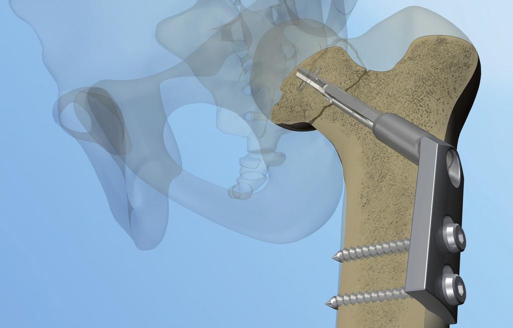 Accanto al chirurgo Il Gannet e un impianto per la sintesi delle fratture di collo femore di ogni tipo e le pertrocanteriche stabili.