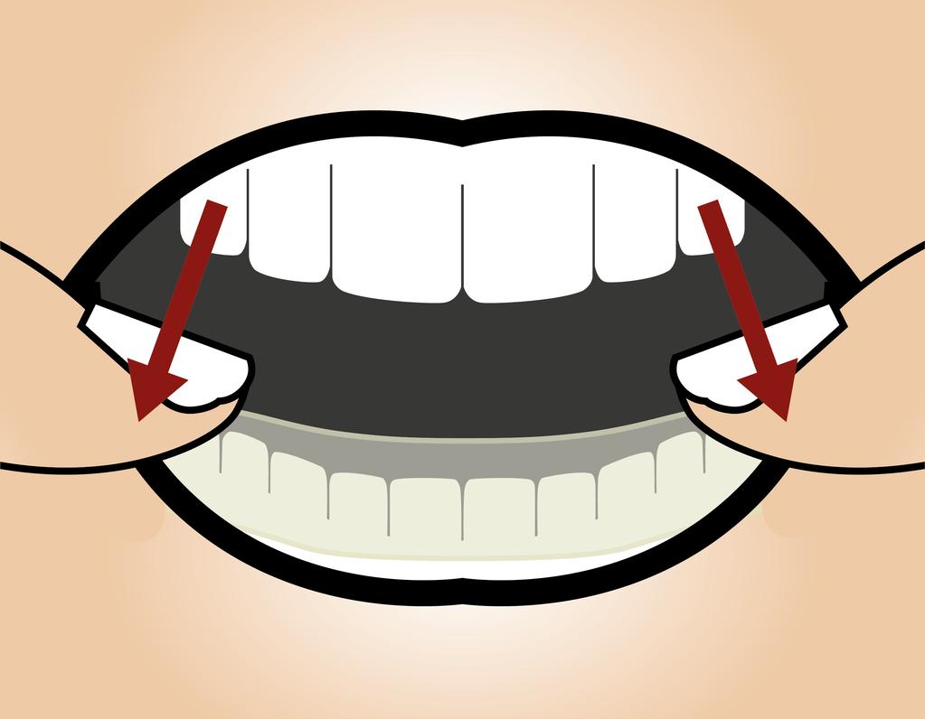 Il bite si aggancia ai denti e dovrebbe essere a questo punto ben fissato.