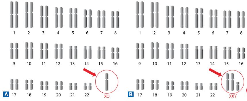14. Le mutazioni genomiche Le mutazioni genomiche si riscontrano quando il numero di cromosomi è maggiore o minore rispetto al numero normale.