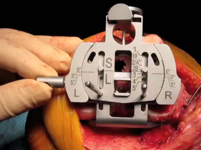 Rotatory Femoral