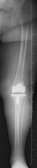 a = 90 +/- 3 AP mechanical axis 0 ± 3 = 94% of cases 4 à 6 varus =