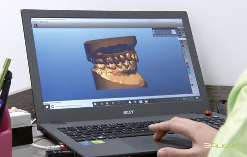 Il set-up è accompagnato dal preventivo di spesa per lo Studio e dal VIDEO CHE SIMULA e visualizza i movimenti dentali passo dopo passo, sino alla