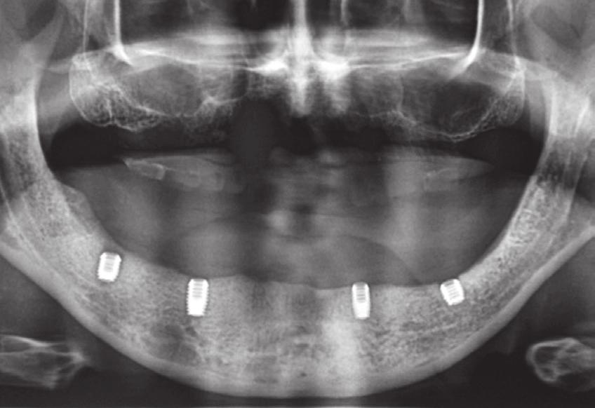 Seguendo la tecnica della Four For All, vengono inseriti due impianti corti (SHORT Implants) nella zona dei canini e altri due nella zona tra primo e secondo molare.