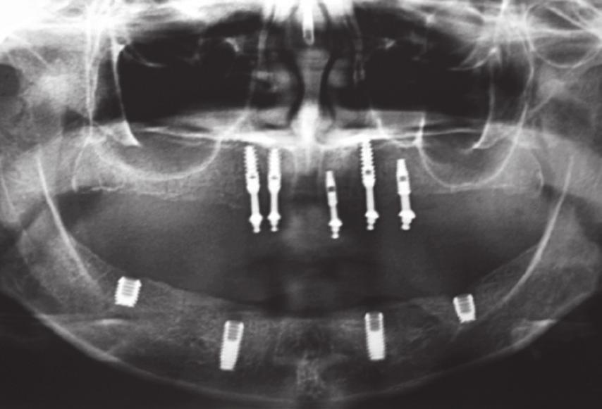 La realizzazione di un caso, con la tecnica All on Four, garantisce al paziente una protesi ibrida su impianti quasi immediata all intervento (tra le 3 e 5 ore tra chirurgia e fissazione della