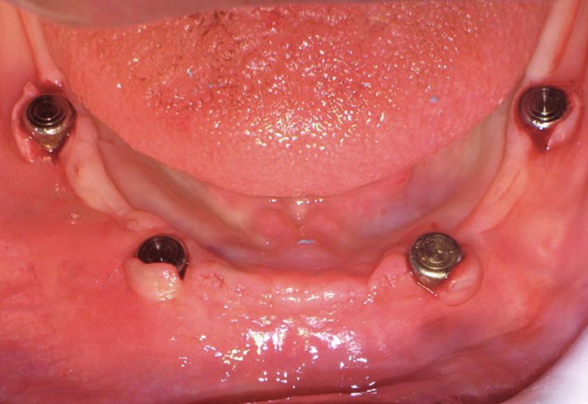 Due impianti di lunghezza 8 mm e del diametro di 4,5 vengono inseriti a livello dei canini e altri due impianti di lunghezza 5 mm e diametro 4 vengono inseriti a livello dei primi molari inferiore