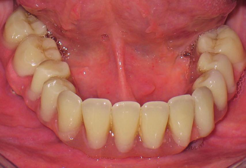 Quest ultima funge semplicemente da sostegno biomeccanico ai denti commerciali e alla restante struttura gengivale in resina (Fig. 9).