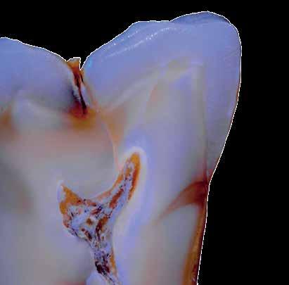 ottimizzazione cromatica del dente, del valore di luminosità nonché della profondità dei restauri in ceramica