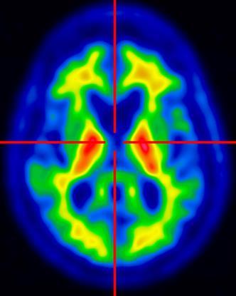 In vivo Brain Amyloid Load in Delirium Patients