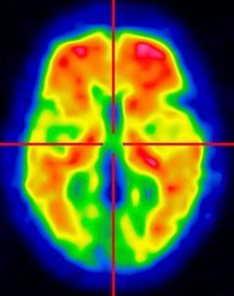 Amyloid positivity D- N = 12 D+ N = 6 p* 5 (42%) 3