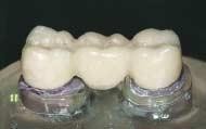 I denti sono esposti ad ingenti carichi derivanti dalla masticazione che possono raggiungere l intensità di alcune centinaia di Newton e portano ad una concentrazione di forze in piccole aree, come
