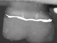 Protezione accurata per denti e parodonto Grazie alla bassa contrazione da polimerizzazione di Protemp 3 Garant, i restauri provvisori si contraddistinguono per l elevata precisione di adattamento e