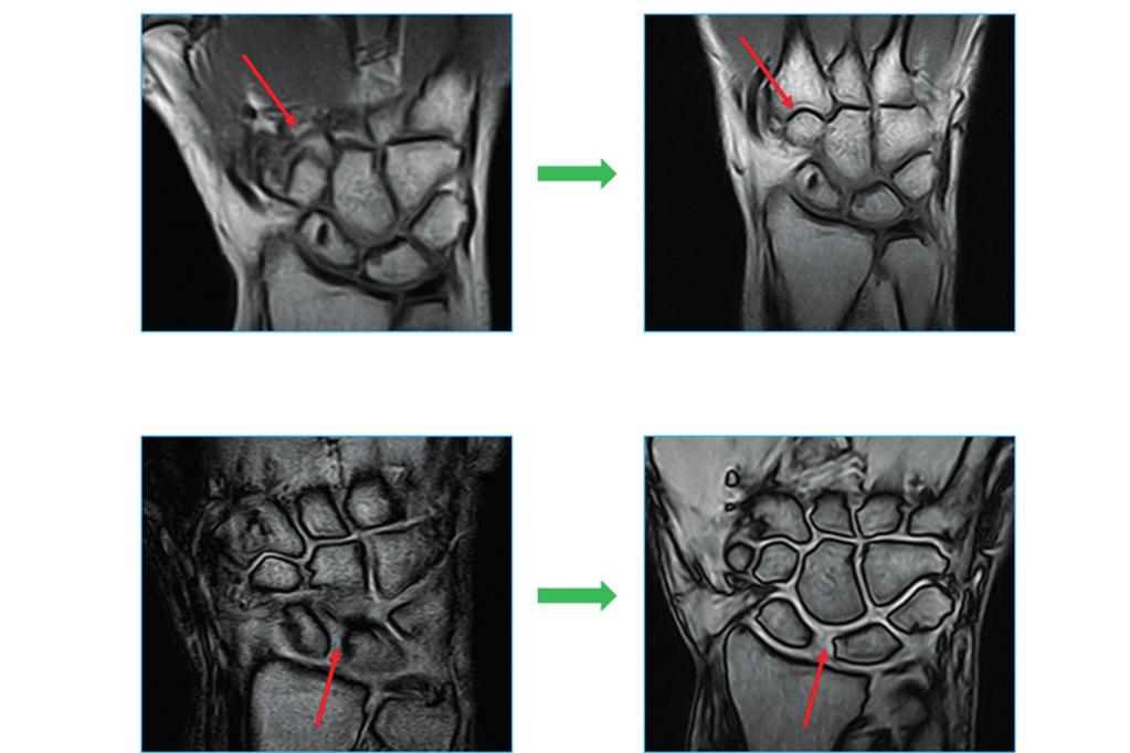 Considerato il peggioramento del quadro articolare si decideva per terapia con adalimumab con progressivo miglioramento del quadro articolare e raggiungimento della remissione clinica.