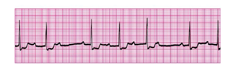 QRS? BAV II