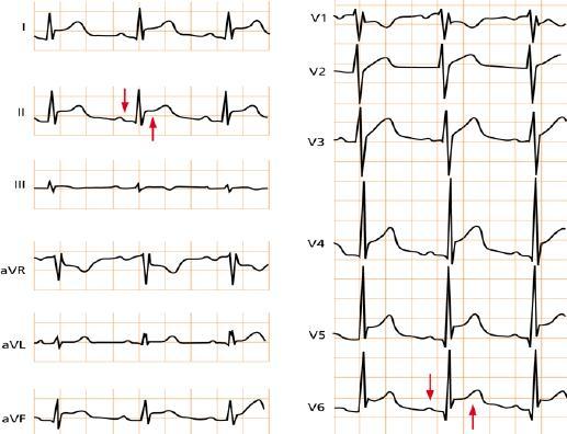 ECG nella