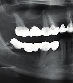 4 Sistema implantare SKY Indicazioni I pazienti che presentano una ridotta porzione ossea necessitano di soluzioni speciali, per poter godere dei vantaggi di una