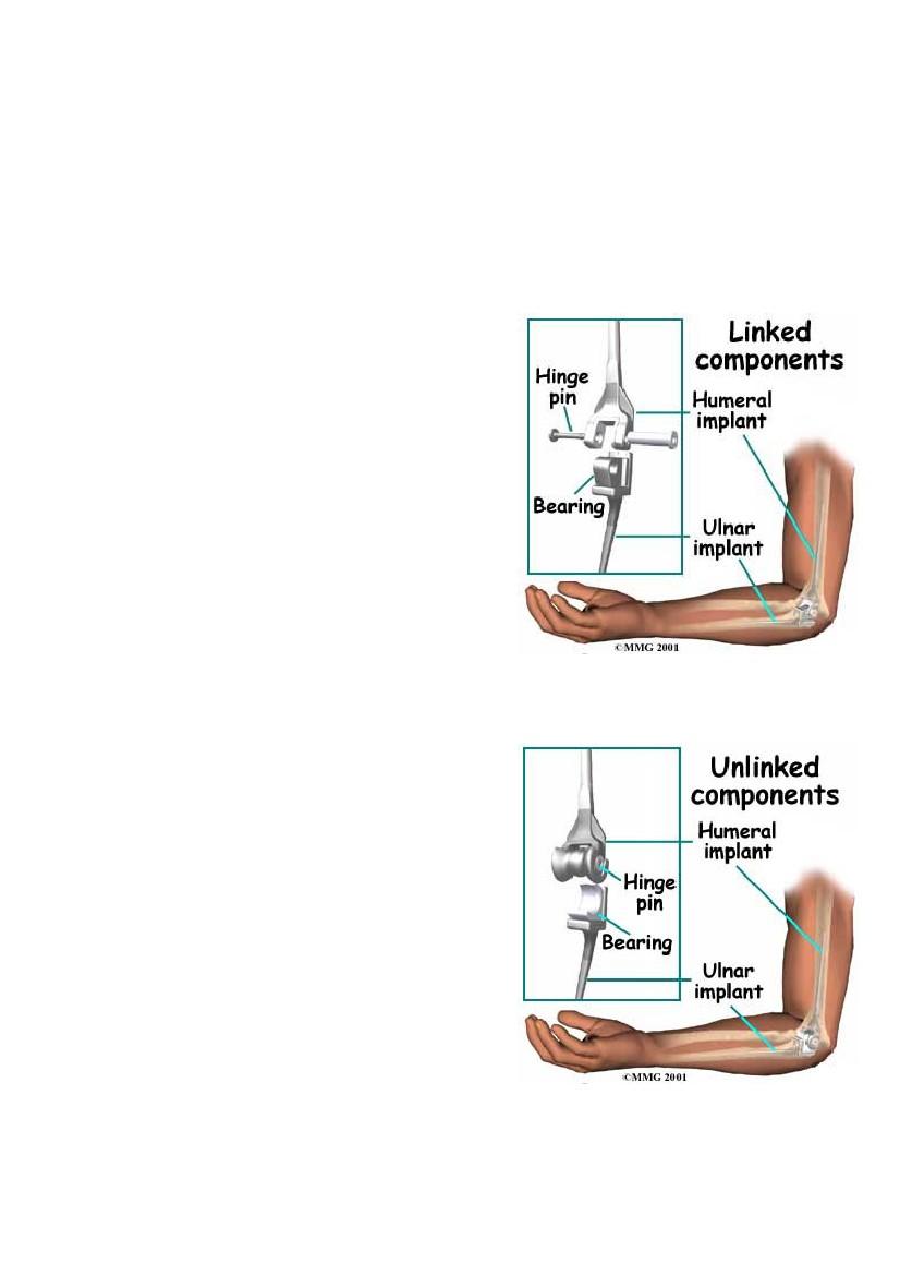 Tipologie di protesi di gomito Esistono due tipologie di protesi di gomito: la protesi linked, ovvero articolata (semi-vincolata) e la protesi unlinked, non articolata (non vincolata).