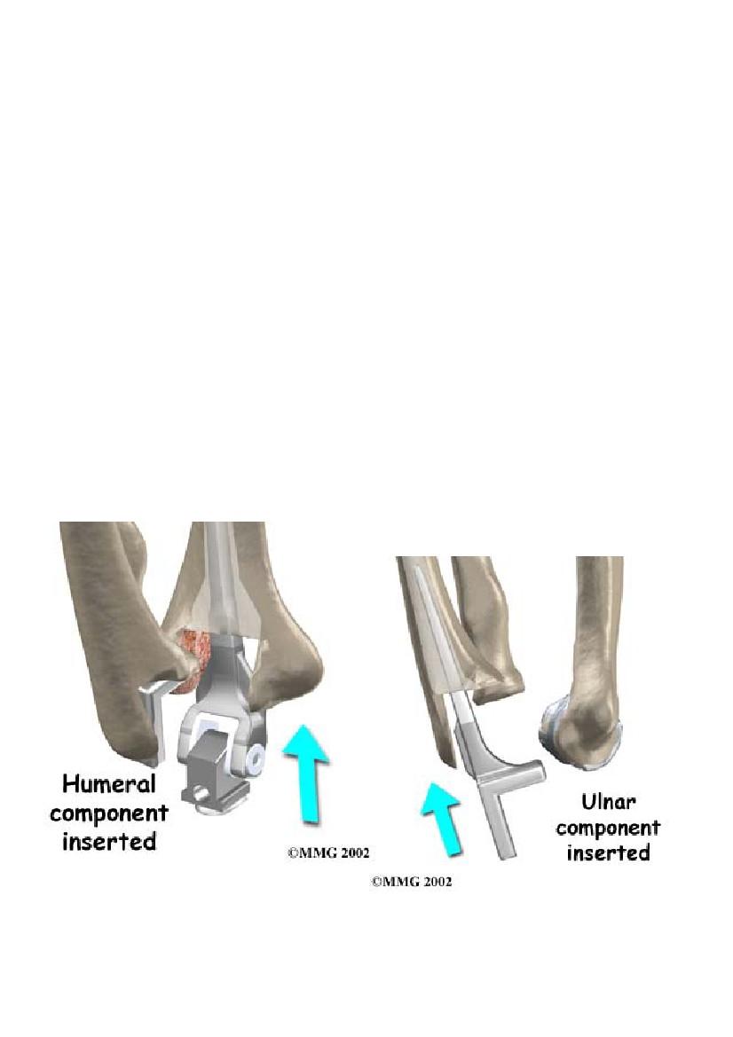 Componenti di una protesi di gomito Una protesi di gomito è costituita da due steli metallici e da un componente di rotolamento. I due steli metallici sono inseriti uno nell omero e l altro nell ulna.