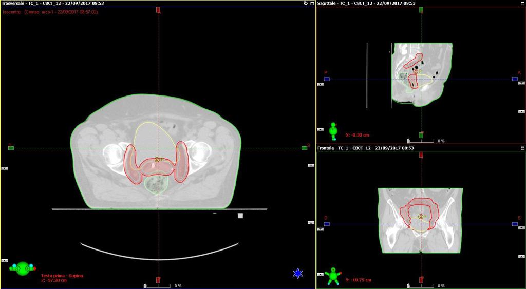 image guided RT (IGRT) CBCT