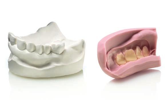 Rimozione della cera e riposizionamento dei denti nella mascherina Riposizionamento della mascherina su modello con scheletrato 5 6 Pesare la resina,