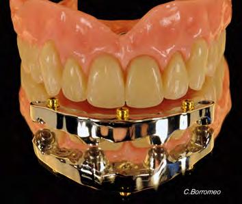 Gli attacchi dentali sono piccoli meccanismi in continuo movimento e sollecitati in modo