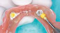 ISTRUZIONI E CONSIGLI TECNICI SOSTITUZIONE DELLE CAPPETTE RITENTIVE: la durata delle cappette in bocca al paziente varia da protesi a protesi, dipende dalla quantità e dalla disposizione