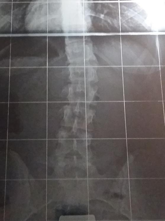 muscolare scoliosi deviazione laterale della colonna con rotazione/ modificazione della struttura ossea delle vertebre, se si verifica a livello dorsale