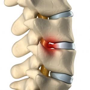 Altre cause Il dolore alla schiena è spesso legato alla sofferenza dei dischi intervertebrali che generano una cattiva distribuzione dei carichi su tutta la colonna.