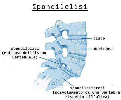 SPONDILOLISTESI: è lo spostamento in avanti della colonna per scivolamento di uno o più corpi vertebrali. E dovuta alla mancata fusione degli archi vertebrali con i processi articolari.