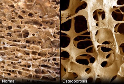 Giulia Cerini OSTEOPOROSI: è una malattia metabolica degenerativa delle ossa, nella quale la fisiologica perdita di materia ossea non viene sufficientemente compensata da una nuova sostanza.