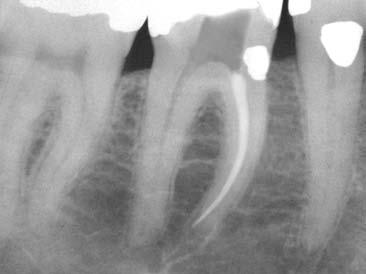 L Informatore Endodontico Vol. 4, Nr. 1 2001 Figura 15 Sempre in presenza di EDTA, il K-file n. 15 scende ancora attraverso il termine del canale di un millimetro, confermando la pervietà apicale.