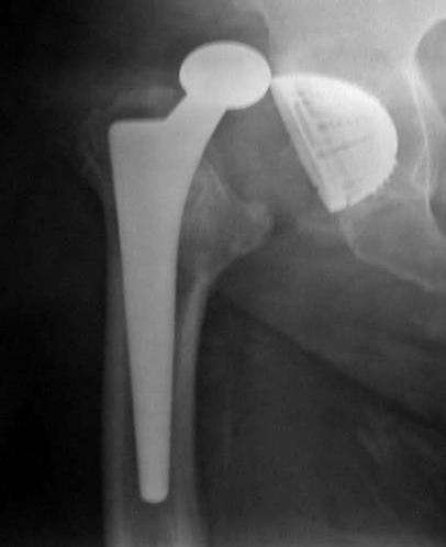 Il rischio di infezioni negli obesi aumenta indipendentemente dalla presenza di co-morbilità (diabete, patologie cardiovascolari) Dowsey M Clin Orthop 2008 Il rischio di infezione