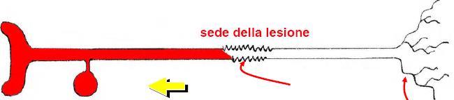 Dolore neuropatico Dolore che insorge nel sistema nervoso periferico o centrale, senza che vi sia una stimolazione dei nocicettori, ma come conseguenza di una alterazione funzionale o di una lesione