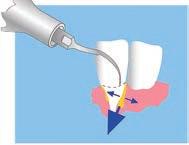 S2 INSERTI SCALING 2 r =9,0 scaling curette universale a sezione triangolare e superficie arrotondata