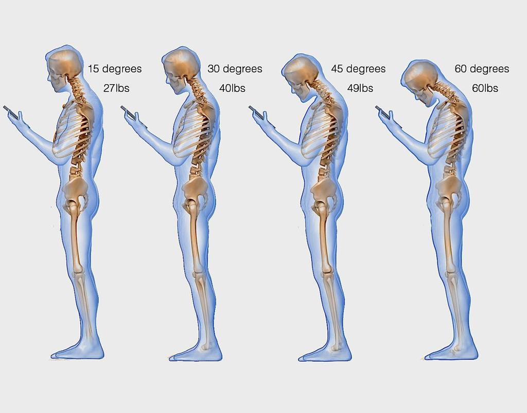 Professionisti di settore, come Osteopati o Fisioterapisti, stanno iniziando ad utilizzare Text o Tech neck a riferimento di una sindrome da iper-utilizzo o lesione causata da uno stress ripetuto