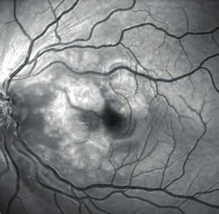 L esame fl uorangiografi co mostra le estese aree di non perfusione capillare e retinica con chiusura di vasi arteriosi e venosi.