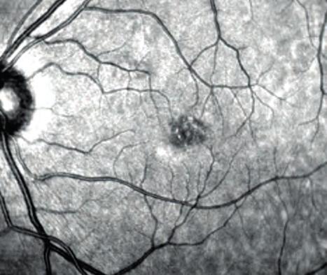 (A) Foto all infrarosso; (B) Fluorangiografi a retinica come una lesione simile alla occlusione dell arteria centrale della retina accompagnandosi,nei casi più gravi, ad emorragie e rottura della