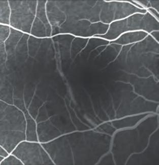 (B) Fluorangiografia retinica: tempi iniziali e (C) tempi tardivi mente al disco ottico o interessanti la fovea.
