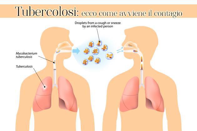 Batteri della tubercolosi vengono diffusi nell ambiente da persone con TB attiva a livello delle vie respiratorie I batteri