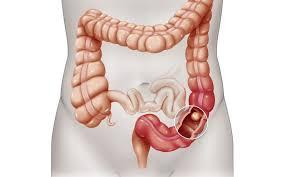 Cancro del Colon Retto Eta > 50 anni IBD Rettocolite ulcerosa Morbo di Crhon Fattori di